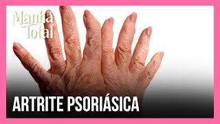 Conheça o novo tratamento aprovado para a artrite psoriásica  MANHÃ TOTAL [upl. by Becka]