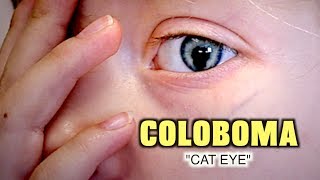 LITTLE GIRL WITH RARE COLOBOMA Cat Eye  Dr Paul [upl. by Nonna]