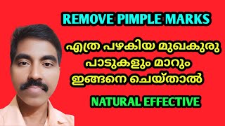 എത്ര പഴകിയ മുഖക്കുരു പാടുകളും മാറാൻ  Remove Pimple And Dark Spots Naturally Suresh Tips A To Z [upl. by Hodosh]