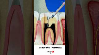 Root Canal Treatment Procedure ↪ 3D Medical Animation Shorts RootCanal Tooth [upl. by Flemming]