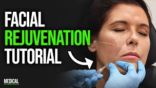 UnderEye amp MidFace Filler for Facial Rejuvenation  Full Procedure Demonstration [upl. by Aical]