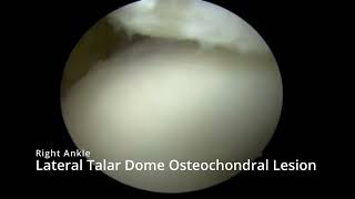 Autologous Collagen Induced Chondrogenesis for Osteochondral Lesions of the Talus [upl. by Attehcnoc]