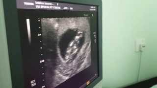 13 weeks ultrasound girl or boy [upl. by Rus]