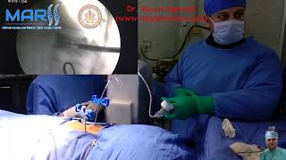 Balloon Kyphoplasty surgical technique by Dr Varun Agarwal wwwmispinecarecom [upl. by Grefe]