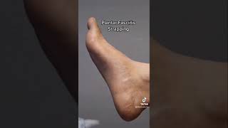 Foot Strapping For Plantar Fasciitis [upl. by Honeywell440]