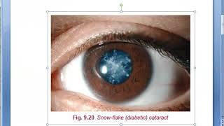 Ophthalmology 202 a Diabetic Cataract Diabetes eye problem vision sorbitol snowflake storm [upl. by Frasquito70]