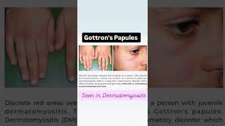 GOTTRONS PAPULES DERMATOMYOSITIS shorts aiapget neetpg viralvideo [upl. by Greenwood]