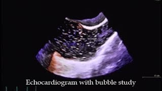 Echocardiogram with bubble study [upl. by Lashondra]