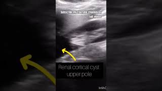 Right Renal upper pole cortical cystUltrasoundkidney [upl. by Thomajan]