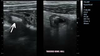 Ultrasound showing Enterocolitis [upl. by Johnath]