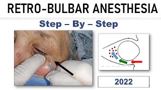 Retrobulbar Block  21 [upl. by Bennet]