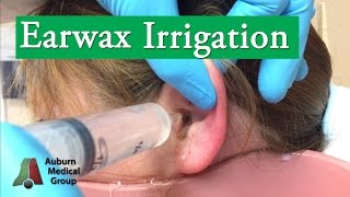 Ear Wax Irrigation  Auburn Medical Group [upl. by Griffis]