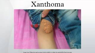 Xanthoma [upl. by Thorr613]