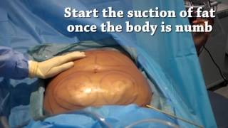 How is liposuction performed  Centre for Surgery [upl. by Mccutcheon]