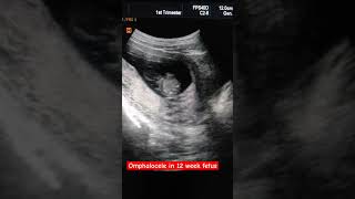 Omphalocele in 12 week fetus [upl. by Winthorpe]