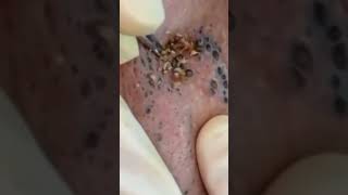 Elderly Blackhead Removal blackheads acne elderly pimplepopping whiteheads satisfying asmr [upl. by Antonio]