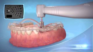 MIS Implants MGUIDE guided Implant placement procedure [upl. by Edmanda]