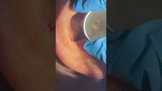 For all my forcep fanboys earwax satisfying ears extractions earcleaning extraction [upl. by Auqcinahs705]