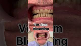 Bleaching in 1 Minute demonstriert  anhand von Dr Grimmels eigenen Zähnen [upl. by Koby421]