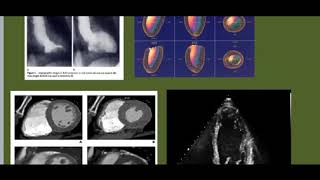 ECHO evaluation in heart failure [upl. by Slater]