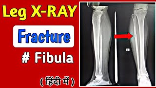 How to read Leg Fracture XRay  Fibula Fracture XRay  टांग का फैक्चर एक्सरे  UdayXray [upl. by Adabelle716]