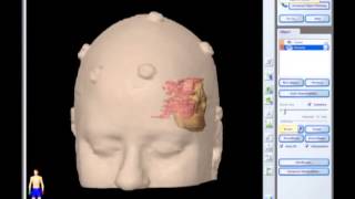 Removal of Brain Tumor Meningioma brain surgery [upl. by Earahc]