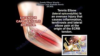 Tennis Elbow Extensor Carpi Radialis Brevis Everything You Need To Know  Dr Nabil Ebraheim [upl. by Nitsua]