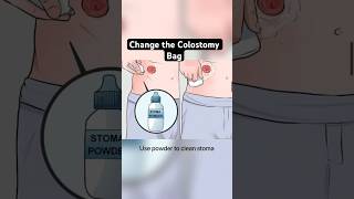 Colostomy care and change colostomy bag procedure steps  nursingofficer norcet aiims nursing [upl. by Alahsal169]