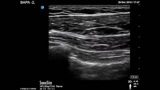 Pectoral muscles scanning [upl. by Doloritas]