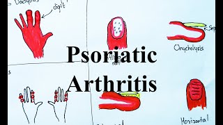 Psoriatic Arthritis Pathogenesis Clinical features and Management Visual learning [upl. by Adnoraj]