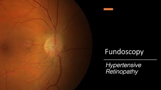 Hypertensive Retinopathy Fundoscopy [upl. by Ynnob]