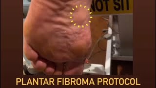 5step protocol for a targeted ultrasound of a plantar fibroma in the foot [upl. by Cassidy]