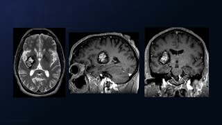 TranssylvianTransinsular Approach for Resection of a Giant Insular Lateral Thalamic Cavernoma [upl. by Ikir574]