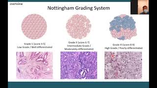 Grading Assesment for Breasst Cancer and its Clinical Application  Surabaya [upl. by Maurilla]