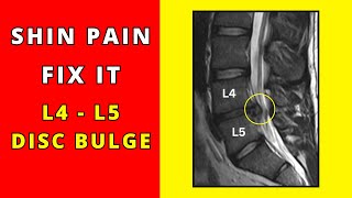 How to fix Shin pain due to lumbar L4  L5 disc bulges [upl. by Mathur]