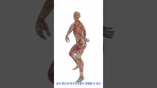 팔꿈치 관절  청소년 박리성 골연골염의 이해 Elbow Joints Understanding Osteochondritis Dissecans in Adolescents [upl. by Dnar]