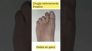 Pie de Atleta Y Cosquillas Pies ASMR [upl. by Saber]