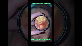 Retinochoroidal coloboma shorts opthalmology neetpg [upl. by Vidal]