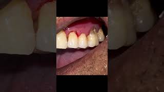 Nano Hybrid Composite Filling for Abfraction 🔥cure for signs of depression in teeth [upl. by Nolyak]