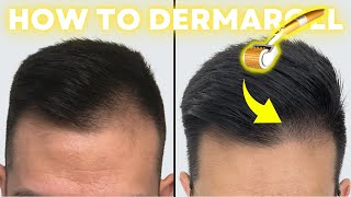 How to Derma Roll for Quickest Hair Results StepbyStep Guide [upl. by Laval]