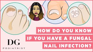 How do you know if you have a fungal nail infection [upl. by Ocir101]