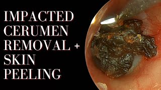 Impacted Cerumen Removal  Skin Peeling [upl. by Bord]