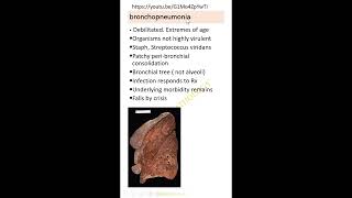 ShortsBroncho pneumonia Dr GSS SRM MCH RC [upl. by Niletak527]