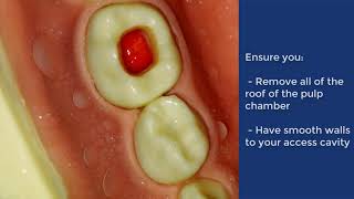 Pulpotomy of Deciduous Molar  QMUL [upl. by Clayson632]