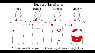 Treating BCell NonHodgkin Lymphoma [upl. by Thorpe]