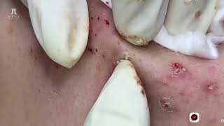 Big Cystic Acne Blackheads Extraction Blackheads amp Milia Whiteheads Removal Pimple Popping [upl. by Tirrej]