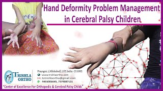 Hand Deformity Problem Management in Cerebral Palsy Children [upl. by Lily]