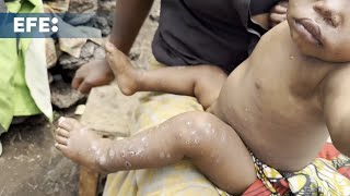 Países africanos reportam 19 mil casos e 540 mortes por mpox ao longo de 2024 [upl. by Ebeohp]