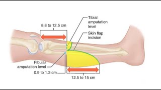 Transtibial Below Knee Amputation for the Ischemic Limbs [upl. by Sundstrom524]