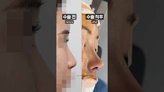 긴 중안면부가 고민이라면 압구정 조원장 코성형✨ short [upl. by Ahsanat518]